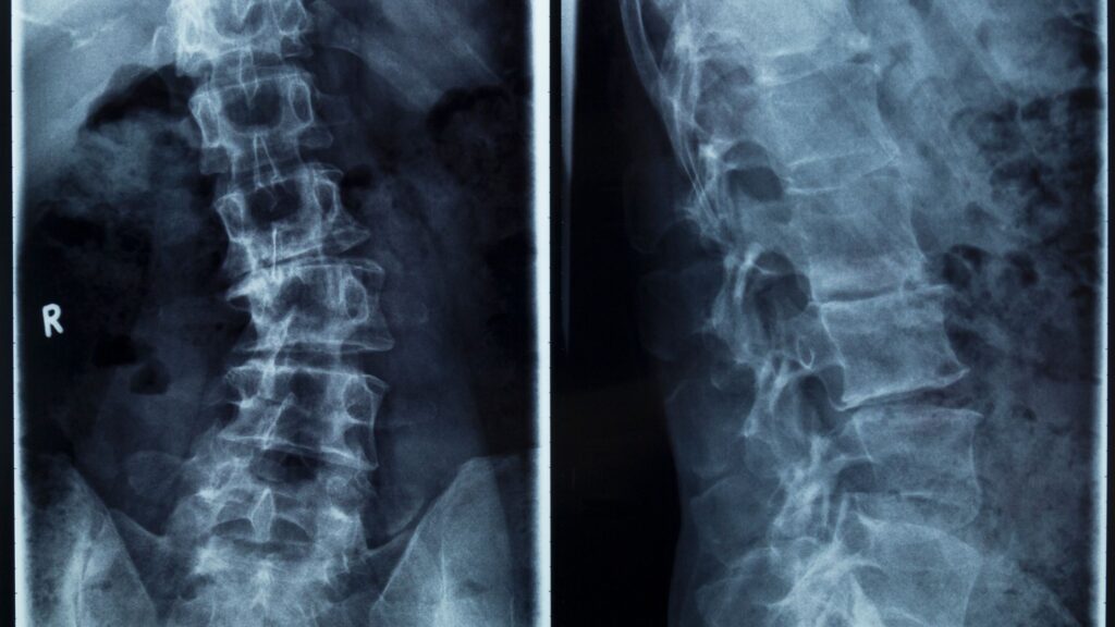 scoliosis pictures next to each other 